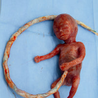 Baby Rob Premature