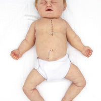 Baby Jules 3-Month-Old Surgery