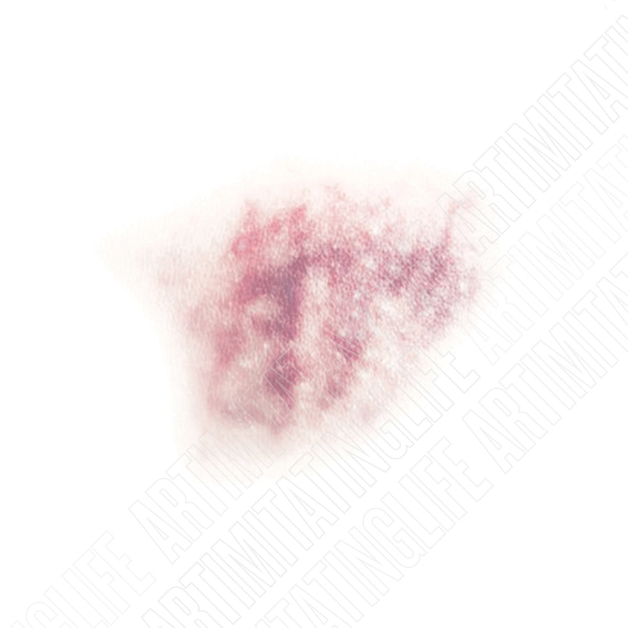 Uneven Bruise