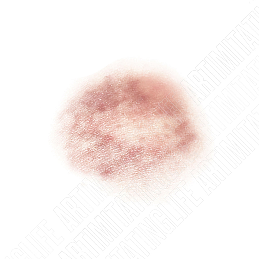 Spotted Bruise