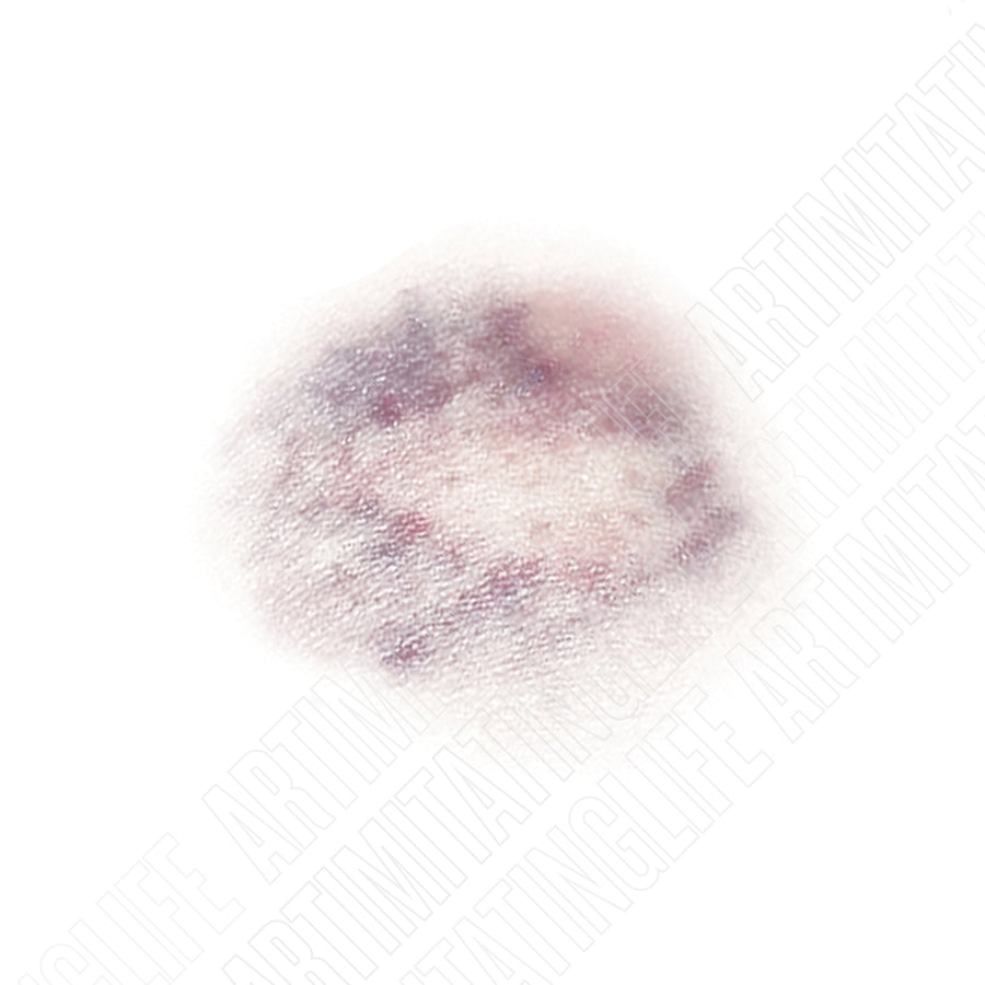 Spotted Bruise