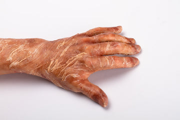 PEELING SKIN (4)