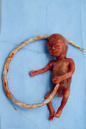 Baby Rob Premature