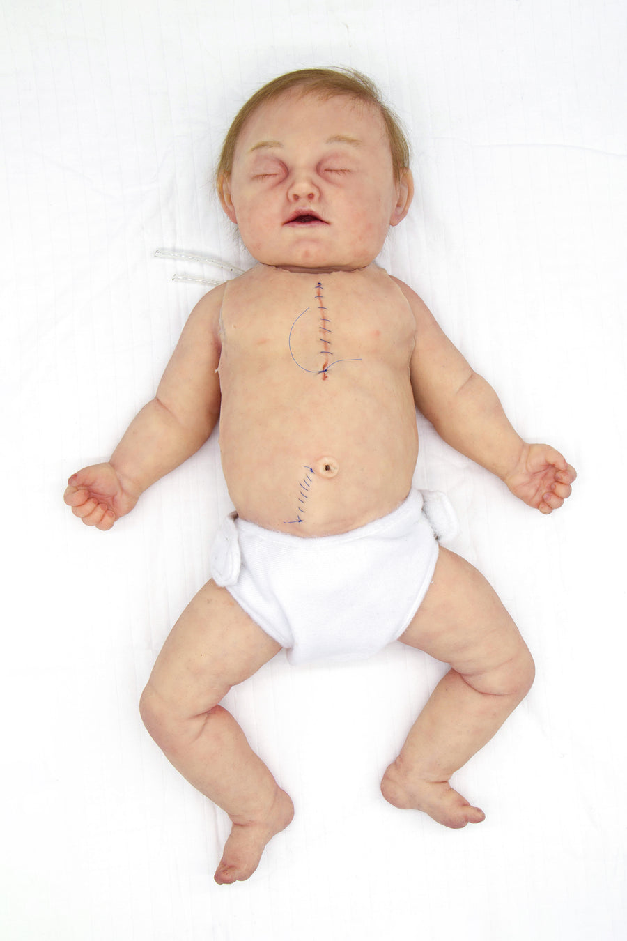 Baby Jules 3-Month-Old Surgery