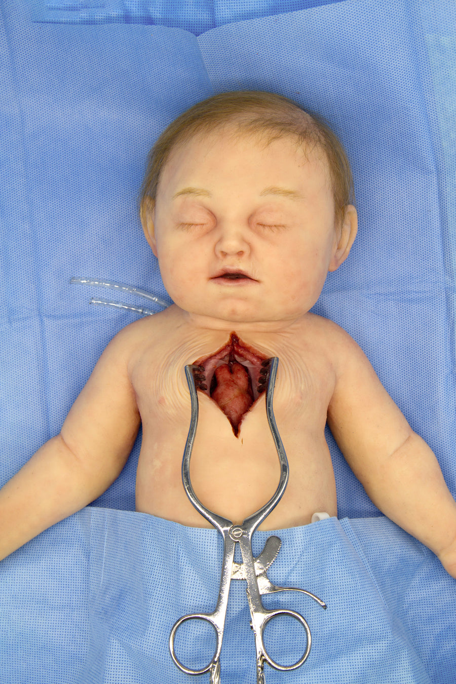 Baby Jules 3-Month-Old Surgery